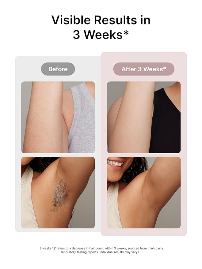 Ulike Laser Hair Removal for Women and Men, Air 3 Ice-Cooling IPL Device Hair Removal for Nearly Painless & Long-Lasting Results, 3 Modes & Auto Flashing for Fast Full Body Hair Removal from Home